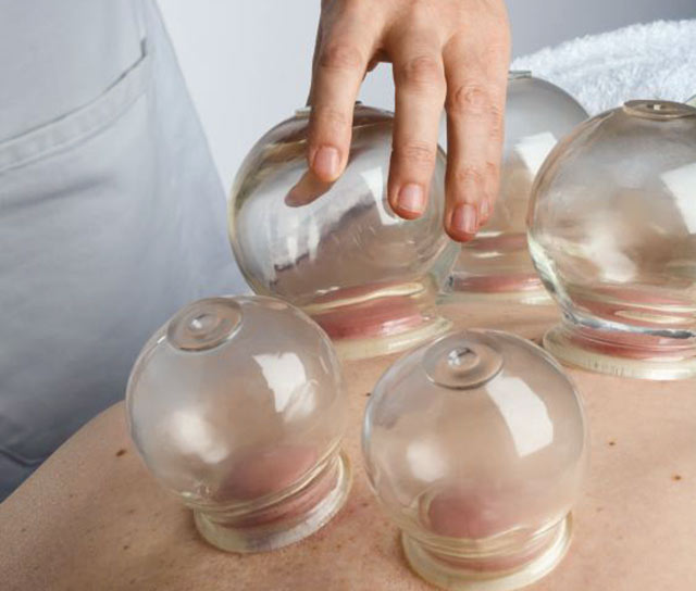 Photo of therapist applying glass cupping jars on a patients back